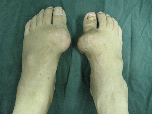 痛風吃什么藥效果最好,痛風吃什么藥好得快