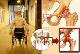 股骨頭壞死可以用通絡生骨膠囊嗎,通絡生骨膠囊怎么服用