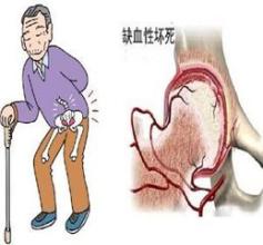 股骨頭壞死可以用通絡(luò)生骨膠囊嗎,股骨頭壞死怎么治療
