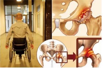 股骨頭壞死治療期間服用注意事項,那些人不能用通絡生骨膠囊