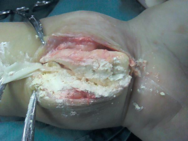 痛風病人不能吃什么,痛風飲食