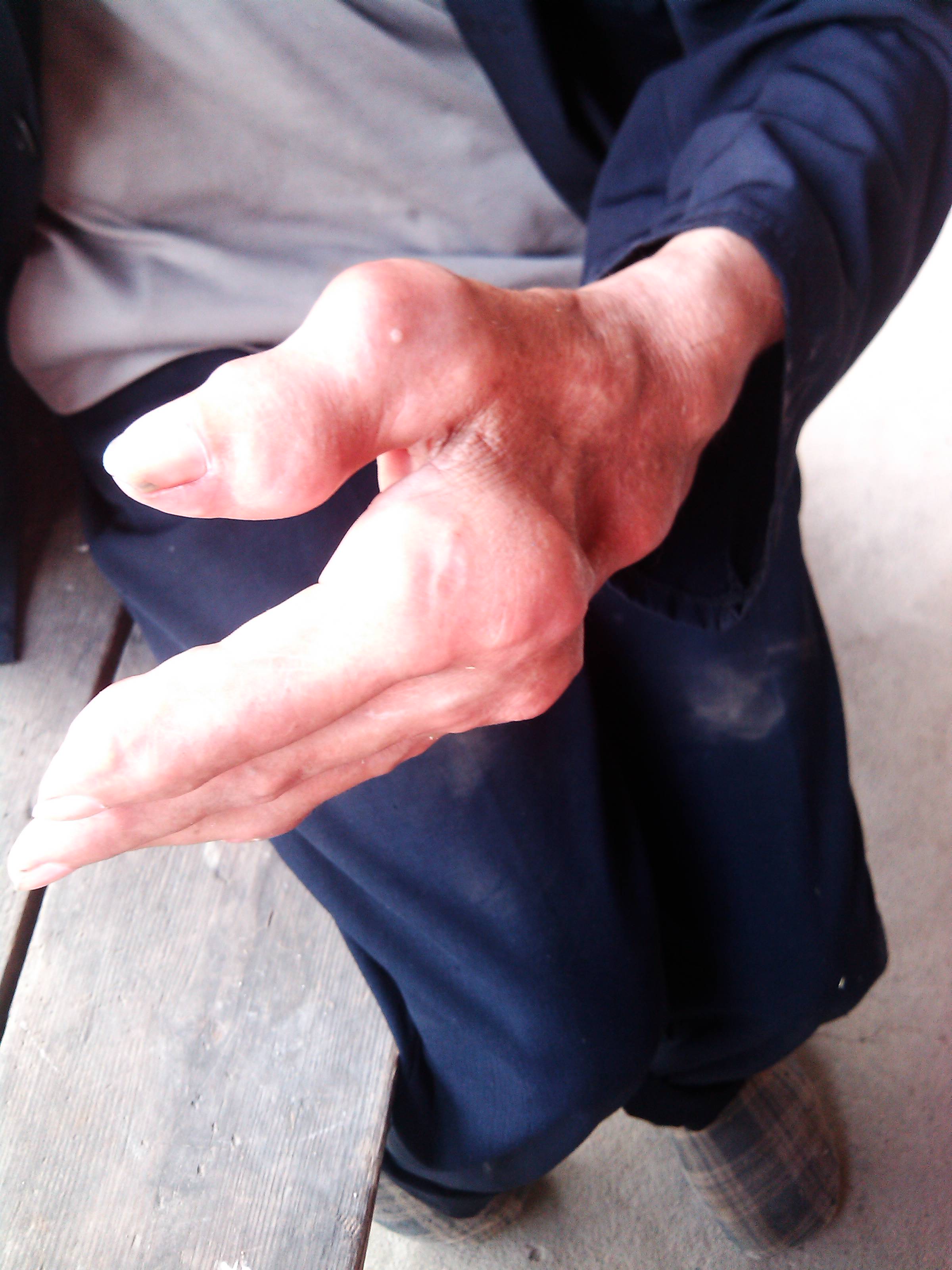 痛風(fēng)吃什么藥,痛風(fēng)吃什么藥效果最好