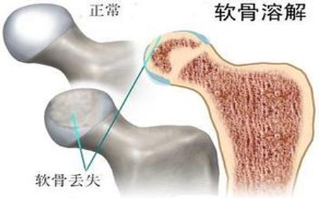 股骨頭壞死吃什么藥好,股骨頭壞死有哪幾個分期