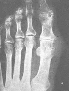 痛風吃什么藥效果最好,痛風用什么藥治療