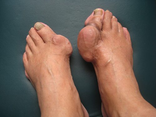 痛風吃什么藥,痛風吃什么藥效果最好