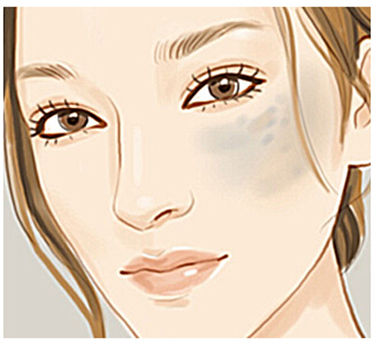 黃褐斑，黃褐斑的表現