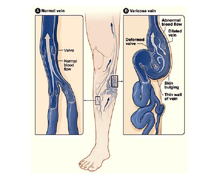 靜脈曲張的危害，邁之靈