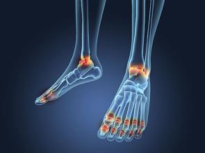 痛風(fēng)病食物,風(fēng)定寧使用療程服用