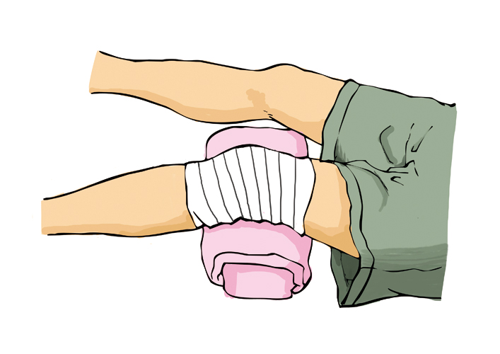 靜脈曲張的預防，邁之靈吃多長時間