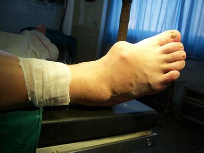 風定寧怎么用,風定寧需要加量嗎