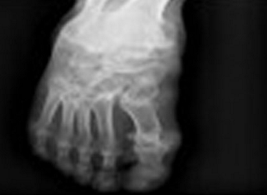 痛風(fēng)吃什么藥效果最好,痛風(fēng)吃什么藥好得快