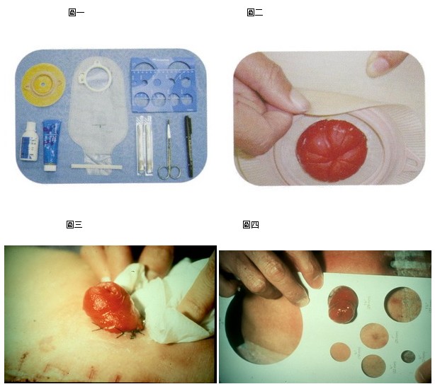 康樂保二件式造口袋，康樂保兩件式造口袋
