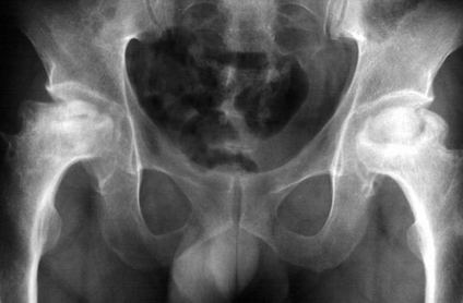 股骨頭壞死的治療，什么是股骨頭壞死