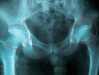 股骨頭壞死的治療，什么是股骨頭壞死