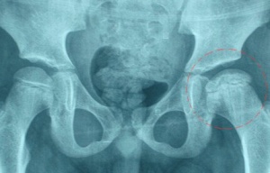 通絡生骨膠囊，通絡生骨膠囊有效嗎