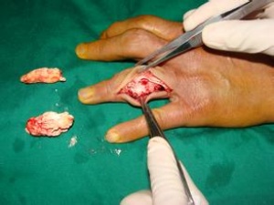 非布司他片可以長期吃嗎，風定寧怎么用