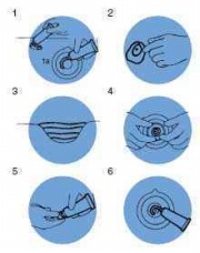 氣管造瘺口的護理，皮膚傷口造口護理常識
