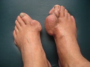 痛風藥，非布司他片