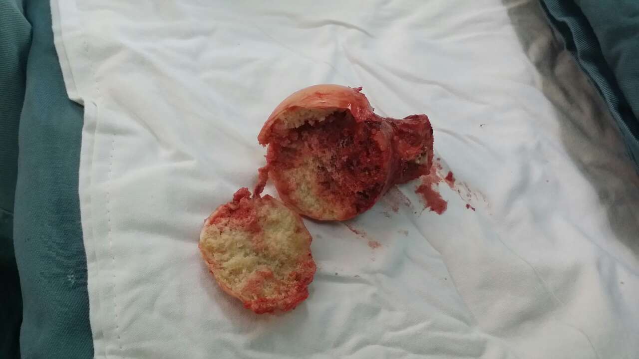 股骨頭壞死治療費用，通絡生骨膠囊在哪里購買