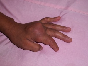 非布司他片，痛風(fēng)吃什么藥好得快