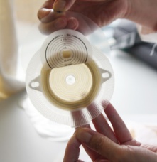 結腸造瘺口護理措施，結腸造口術后護理