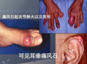 痛風吃什么藥，痛風吃什么藥效果最好
