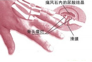 痛風吃什么藥，痛風吃什么藥效果最好