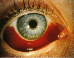 治療糖尿病視網膜病變的費用，芪明顆粒產地在哪