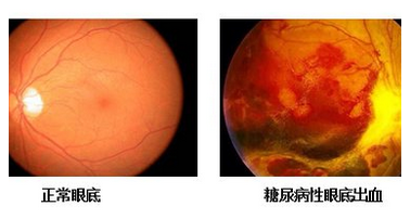 哪些人不能用芪明顆粒，糖尿病視網膜病變服藥注意
