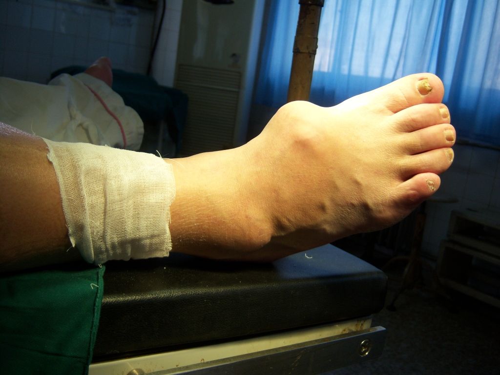 痛風吃什么藥，痛風吃什么藥效果最好